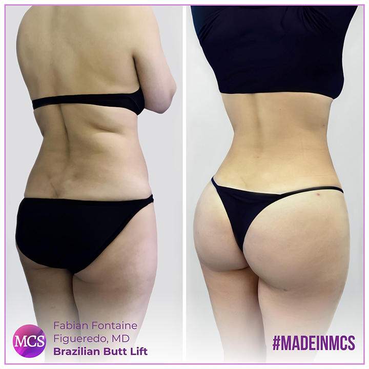 Before and after comparison of a Brazilian Butt Lift performed by Dr. Fabian Fontaine Figueredo. The 'Before' image shows the initial appearance, while the 'After' image showcases a sculpted and elegantly enhanced buttocks.