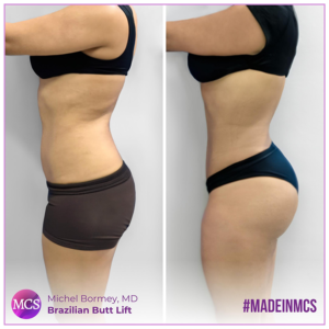 Before and after comparison of a Brazilian Butt Lift performed by Dr. Michel Bormey Garcia. The 'Before' image displays the original appearance, while the 'After' image showcases sculpted and enhanced buttocks.