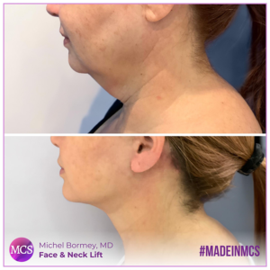 Before and after comparison of a Face and Neck Lift performed by Dr. Michel Bormey Garcia. The 'Before' image shows the original appearance, while the 'After' image reveals a rejuvenated and elegantly lifted face and neck.