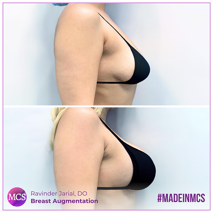Before and after comparison of a Breast Augmentation performed by Dr. Ravinder Jarial. The 'Before' image shows the original appearance, while the 'After' image displays enhanced and beautifully augmented breasts.