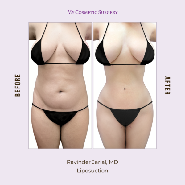 Before and after images of liposuction performed by Dr. Ravinder Jarial at My Cosmetic Surgery in Miami.