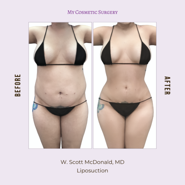 Dr. W. Scott McDonald presenting before-and-after results of a liposuction procedure at My Cosmetic Surgery in Miami.