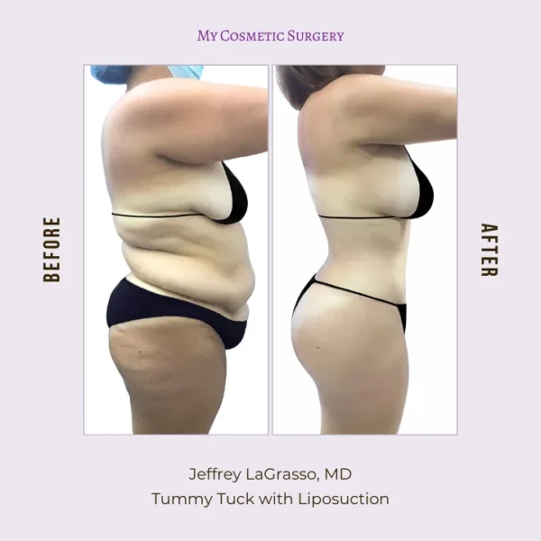 My Cosmetic Surgery website showcasing Dr. Jeffrey Lagrasso, MD, performing tummy tuck with liposuction procedures; emphasizing body transformation and enhanced contours in Miami.