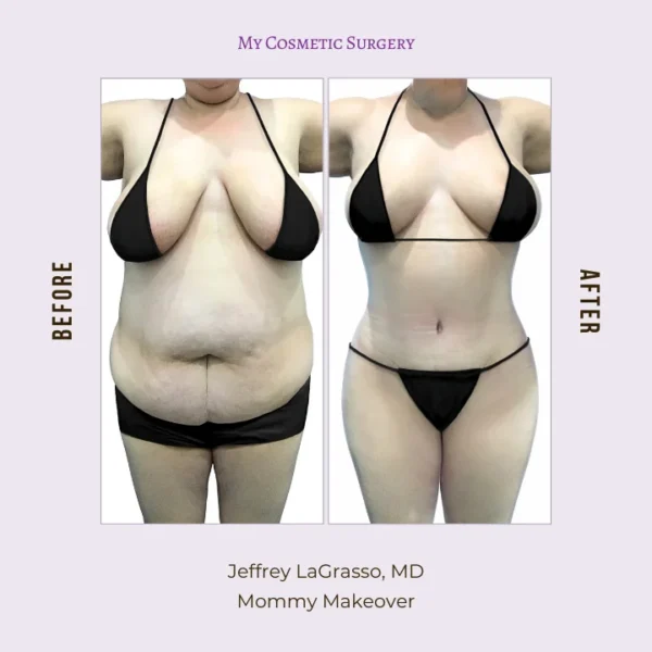 My Cosmetic Surgery website featuring Dr. Jeffrey Lagrasso, MD, highlighting the Mommy Makeover procedure; showcasing transformations for mothers seeking body rejuvenation in Miami.