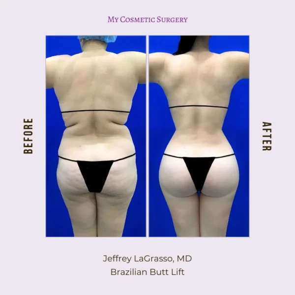 My Cosmetic Surgery website showcasing Dr. Jeffrey Lagrasso, MD, performing tummy tuck with liposuction procedures; emphasizing body transformation and enhanced contours in Miami.