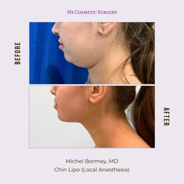 Before and after comparison of chin liposuction by Dr. Michel Bormey at My Cosmetic Surgery in Miami.