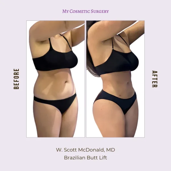 My Cosmetic Surgery website featuring Dr. W. Scott McDonald, MD, performing Brazilian Butt Lift procedures; highlighting body transformation and enhanced curves in Miami.