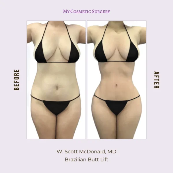 My Cosmetic Surgery website featuring Dr. W. Scott McDonald, MD, performing Brazilian Butt Lift procedures; highlighting body transformation and enhanced curves in Miami.