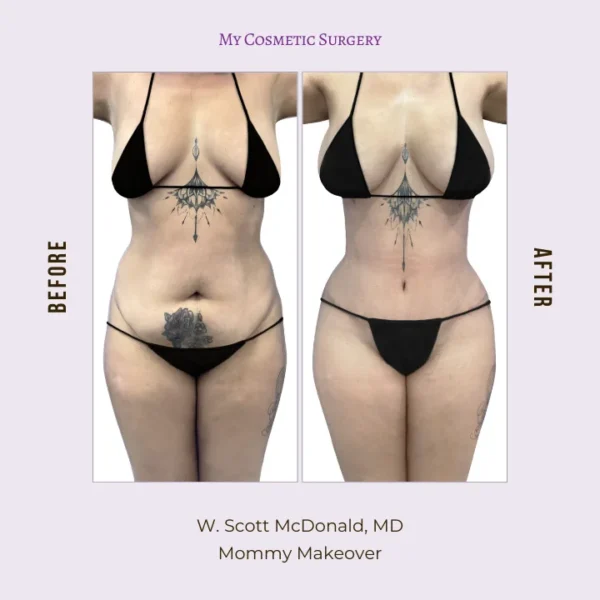 My Cosmetic Surgery website featuring Dr. W. Scott McDonald, MD, specializing in Mommy Makeover procedures; highlighting body transformation and personalized care in Miami.