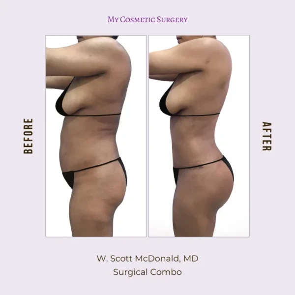 My Cosmetic Surgery website featuring Dr. W. Scott McDonald, MD, showcasing surgical combo procedures; emphasizing efficient recovery and comprehensive aesthetic solutions in Miami.