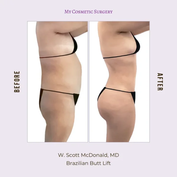 My Cosmetic Surgery website featuring Dr. W. Scott McDonald, MD, performing Brazilian Butt Lift procedures; highlighting body transformation and enhanced curves in Miami.My Cosmetic Surgery website featuring Dr. W. Scott McDonald, MD, performing Brazilian Butt Lift procedures; highlighting body transformation and enhanced curves in Miami.