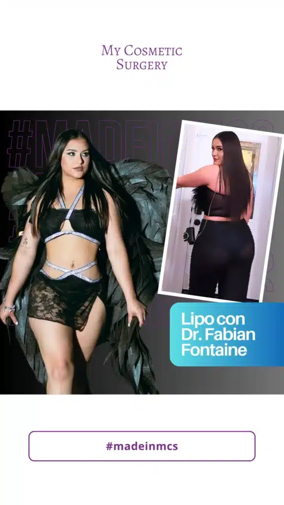 Resultados de antes y después de un procedimiento de liposucción realizado por el Dr. Fabian Fontaine en My Cosmetic Surgery Miami.