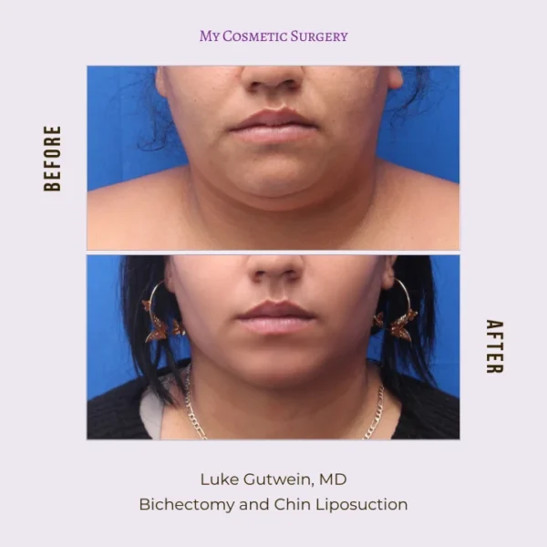 My Cosmetic Surgery website displaying before and after results of bichectomy and chin liposuction; highlighting facial contouring and definition transformations in Miami.