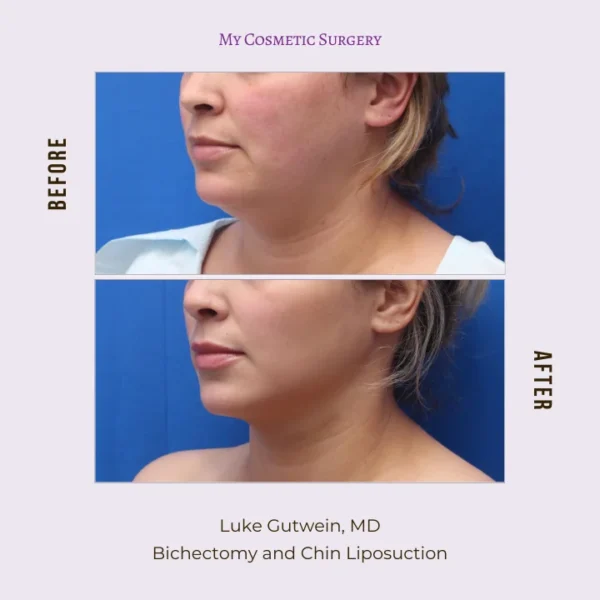 My Cosmetic Surgery website showing before and after images of bichectomy and chin liposuction, emphasizing facial contouring and profile enhancement in Miami.