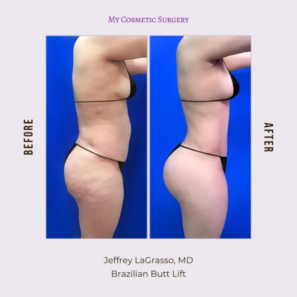 Before and after results of a Brazilian Butt Lift (BBL) at My Cosmetic Surgery Miami, showcasing a successful body transformation.