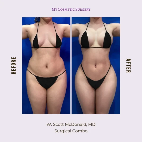 Before and after images showcasing successful surgical combo results at My Cosmetic Surgery Miami, highlighting the clinic's expertise in body transformation.