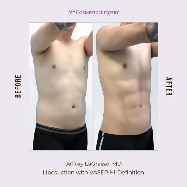 My Cosmetic Surgery clinic website showcasing VASER Hi-Definition Liposuction services in Miami; professional plastic surgery environment with body contouring focus.