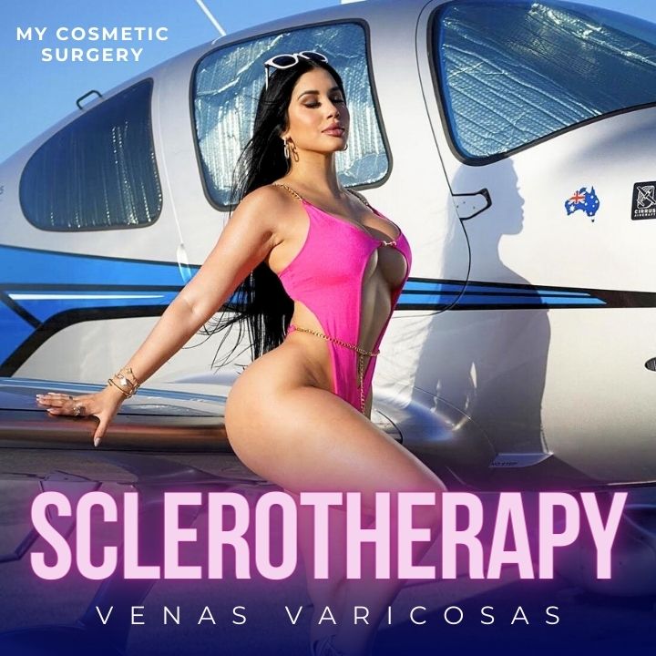 My Cosmetic Surgery website's sclerotherapy service page, showcasing treatment details for reducing varicose and spider veins in Miami.