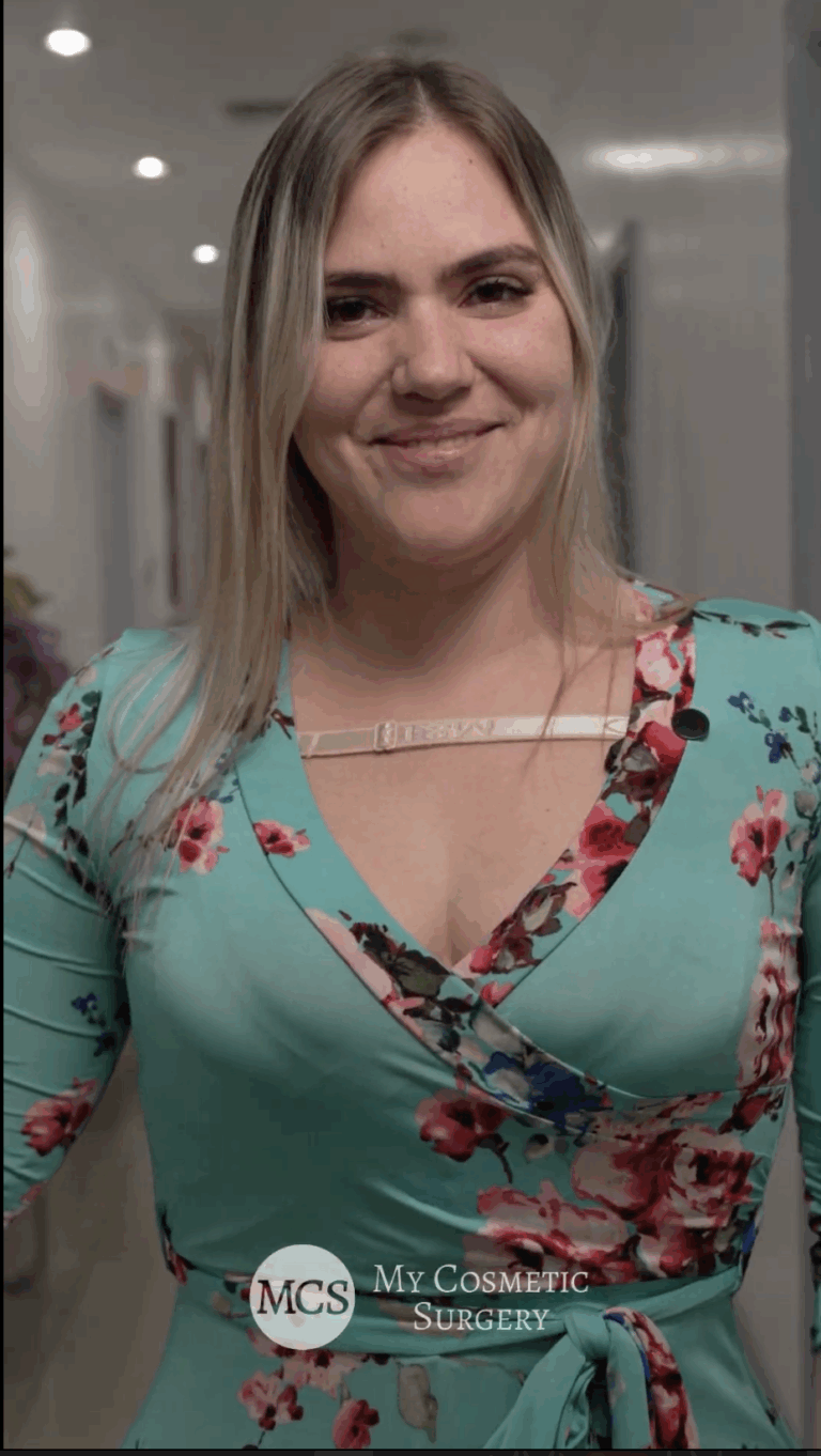 BBL testimonial patient result associated with Fabian Fontaine Figueredo, MD at My Cosmetic Surgery Miami highlighting body contour improvement and confidence.