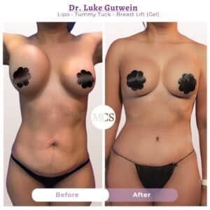 Before and after cosmetic surgery transformation at My Cosmetic Surgery Miami by Dr. Luke Gutwein, showing liposuction, tummy tuck, and breast lift with gel results.