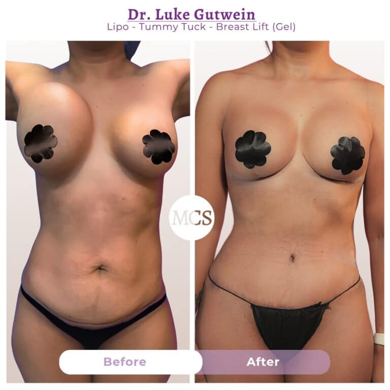 Before and after cosmetic surgery transformation at My Cosmetic Surgery Miami by Dr. Luke Gutwein, showing liposuction, tummy tuck, and breast lift with gel results.