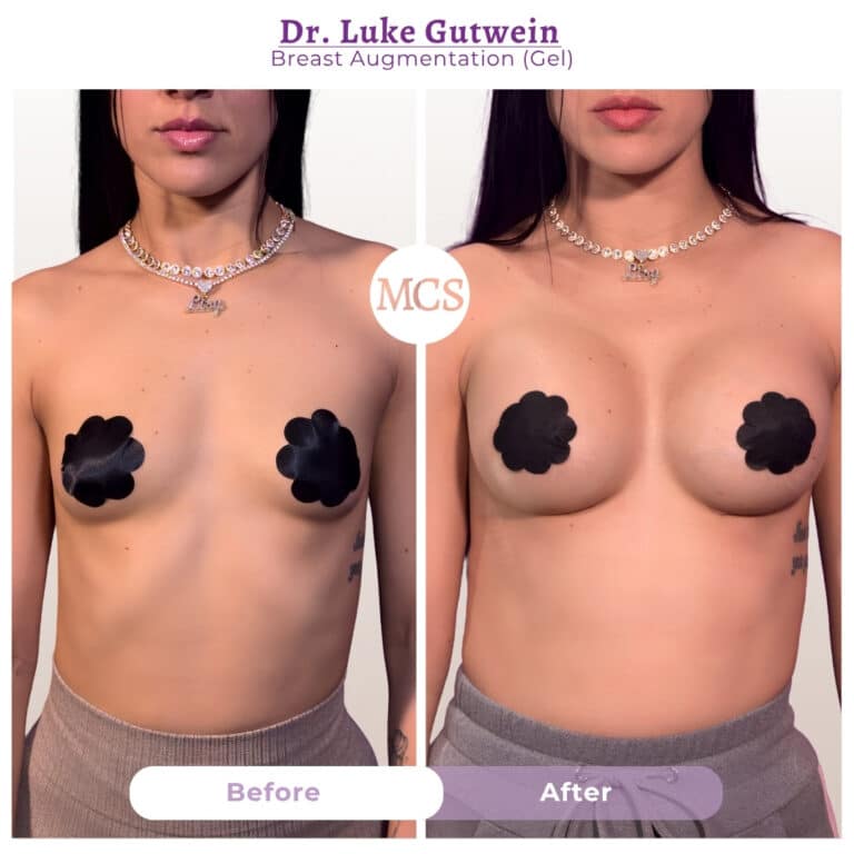 Before and after breast augmentation transformation at My Cosmetic Surgery Miami by Dr. Luke Gutwein, showing gel breast augmentation results.