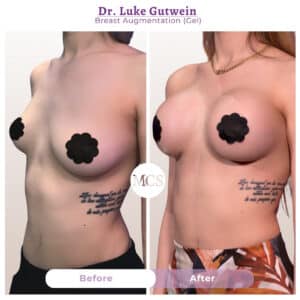 Before and after breast augmentation transformation at My Cosmetic Surgery Miami by Dr. Luke Gutwein, showing gel breast augmentation results from an angled side-view comparison.