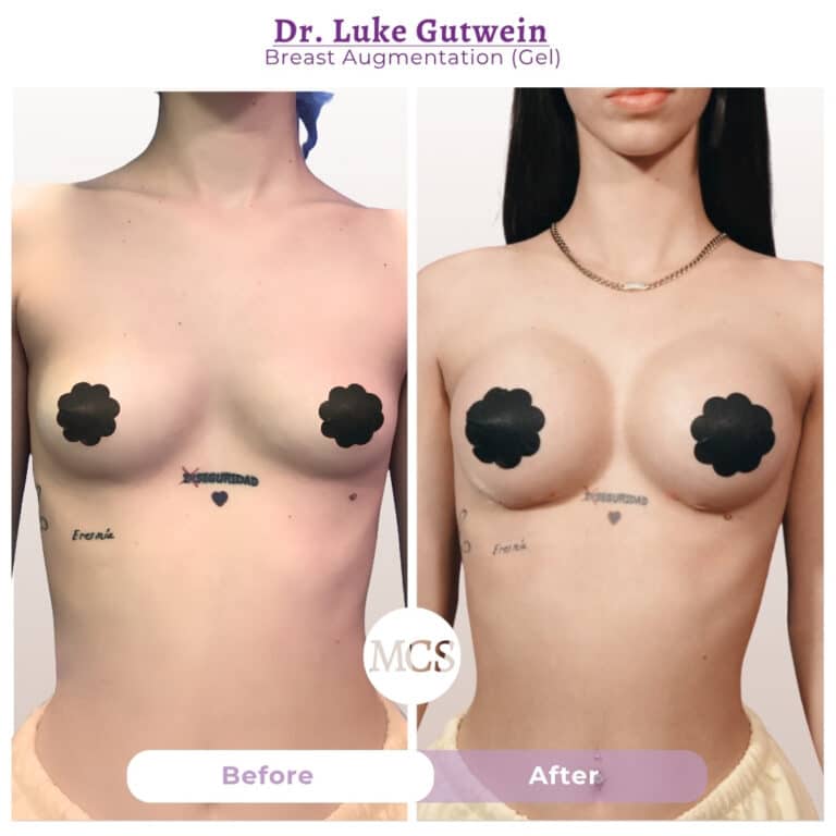 Before and after breast augmentation transformation at My Cosmetic Surgery Miami by Dr. Luke Gutwein, showing gel breast augmentation results from a front-view comparison.