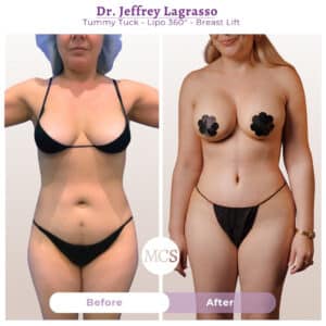 Before and after cosmetic surgery transformation at My Cosmetic Surgery Miami by Dr. Jeffrey LaGrasso, showing tummy tuck, Lipo 360, and breast lift results from a front-view comparison.