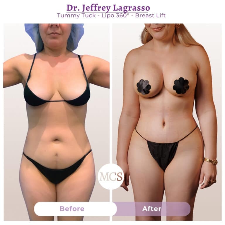 Before and after cosmetic surgery transformation at My Cosmetic Surgery Miami by Dr. Jeffrey LaGrasso, showing tummy tuck, Lipo 360, and breast lift results from a front-view comparison.