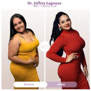 Before and after cosmetic surgery transformation at My Cosmetic Surgery Miami by Dr. Jeffrey LaGrasso, showing BBL and tummy tuck results from a side-view comparison.
