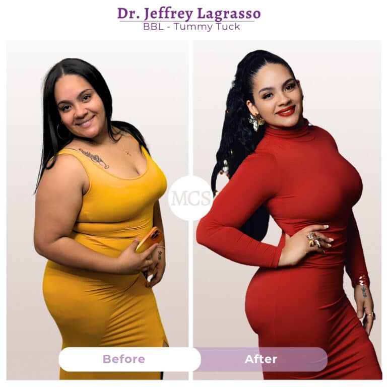 Before and after cosmetic surgery transformation at My Cosmetic Surgery Miami by Dr. Jeffrey LaGrasso, showing BBL and tummy tuck results from a side-view comparison.
