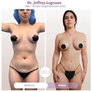 Before and after cosmetic surgery transformation at My Cosmetic Surgery Miami by Dr. Jeffrey LaGrasso, showing BBL and gel breast augmentation results from a front-view comparison.