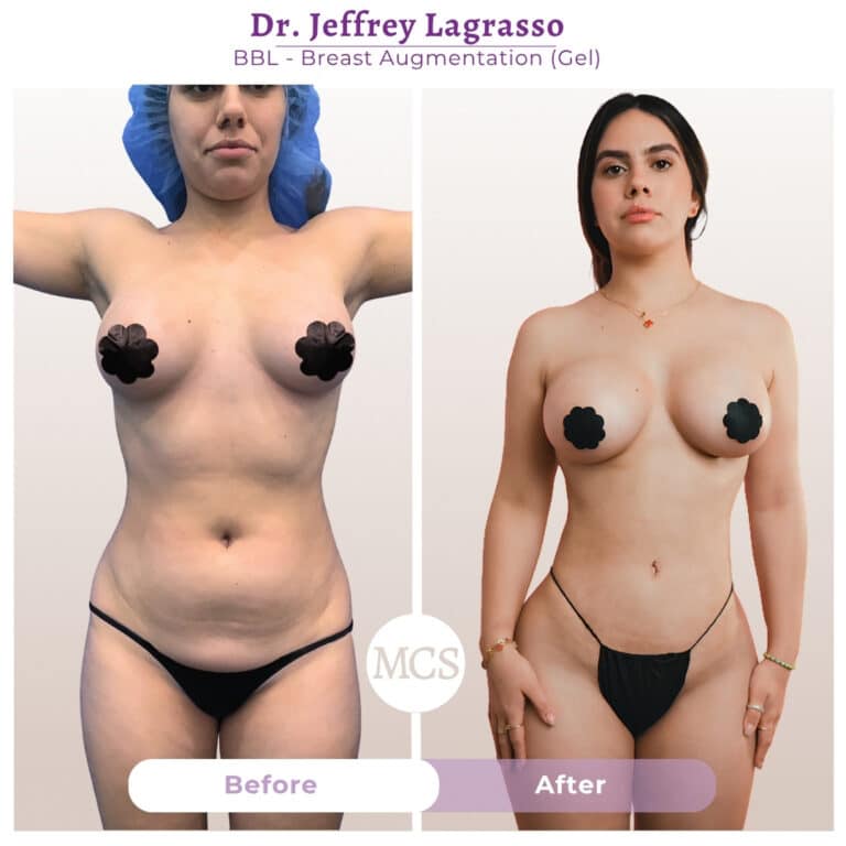 Before and after cosmetic surgery transformation at My Cosmetic Surgery Miami by Dr. Jeffrey LaGrasso, showing BBL and gel breast augmentation results from a front-view comparison.