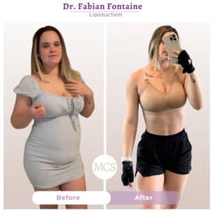 Before and after liposuction results performed by Dr. Fabian Fontaine at My Cosmetic Surgery Miami, showing body contouring transformation.
