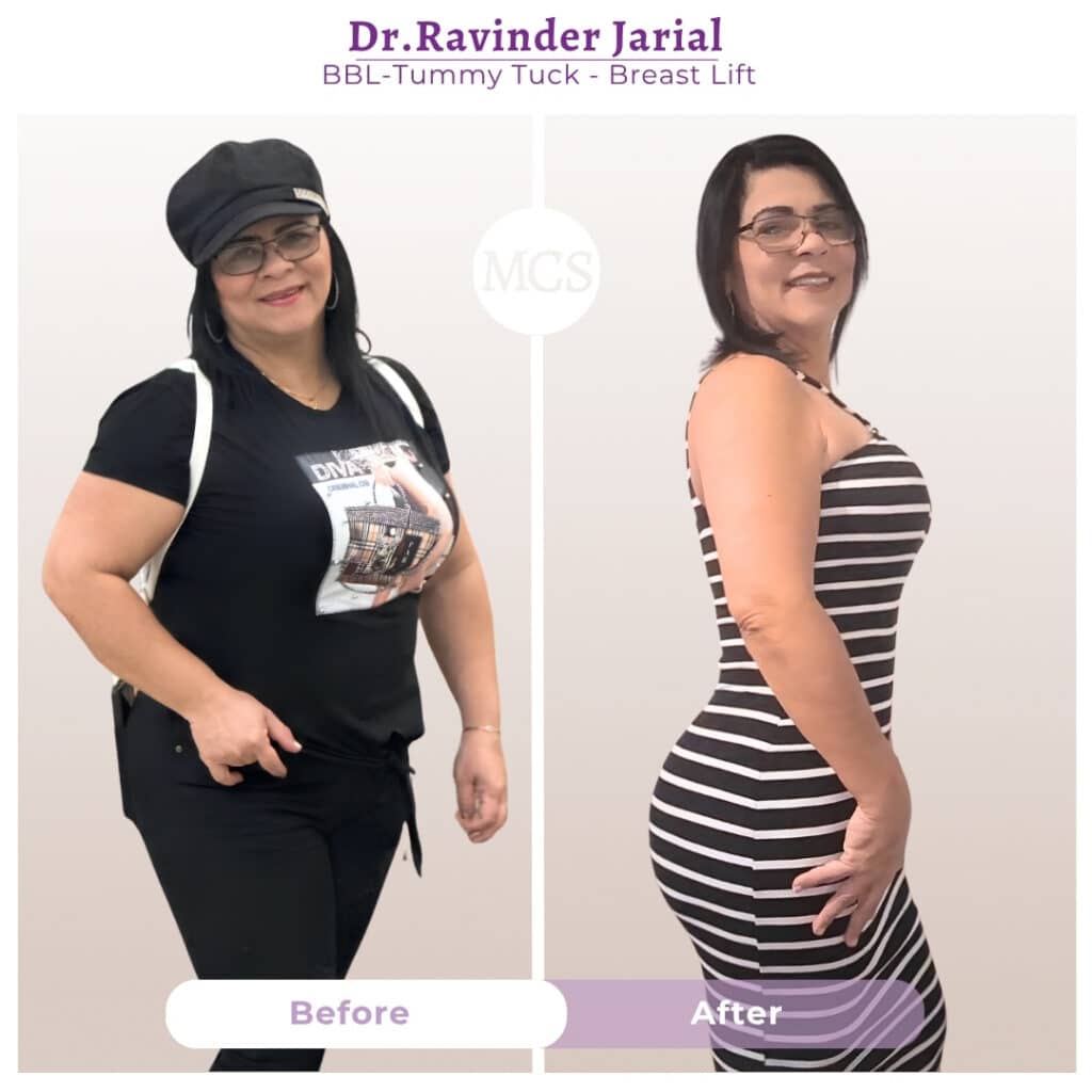 Before and after results of a BBL, tummy tuck, and breast lift performed by Dr. Ravinder Jarial at My Cosmetic Surgery Miami.
