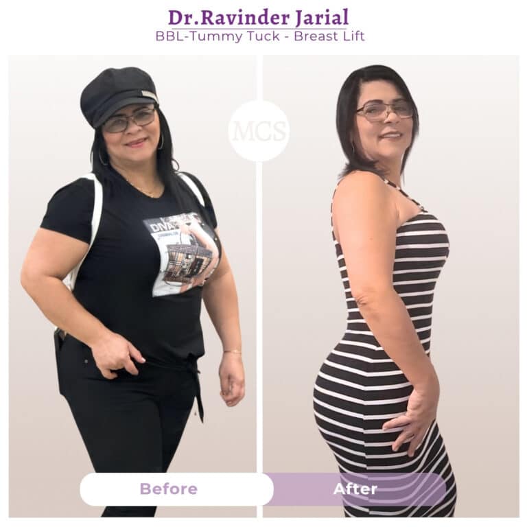 Before and after results of a BBL, tummy tuck, and breast lift performed by Dr. Ravinder Jarial at My Cosmetic Surgery Miami.