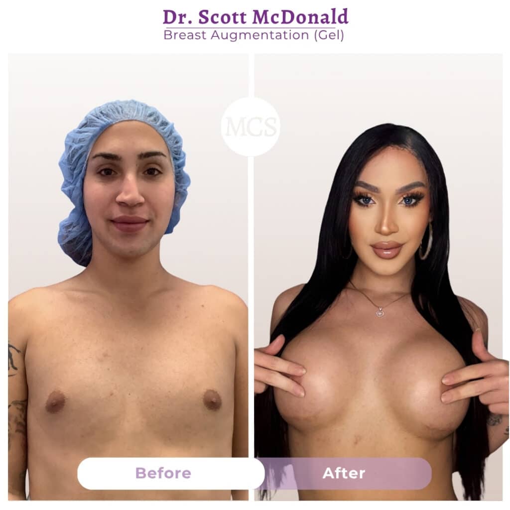 Before and after breast augmentation results performed by Dr. Scott McDonald at My Cosmetic Surgery Miami.