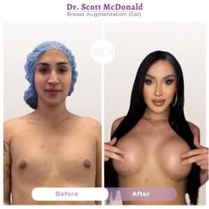 Before and after breast augmentation results performed by Dr. Scott McDonald at My Cosmetic Surgery Miami.