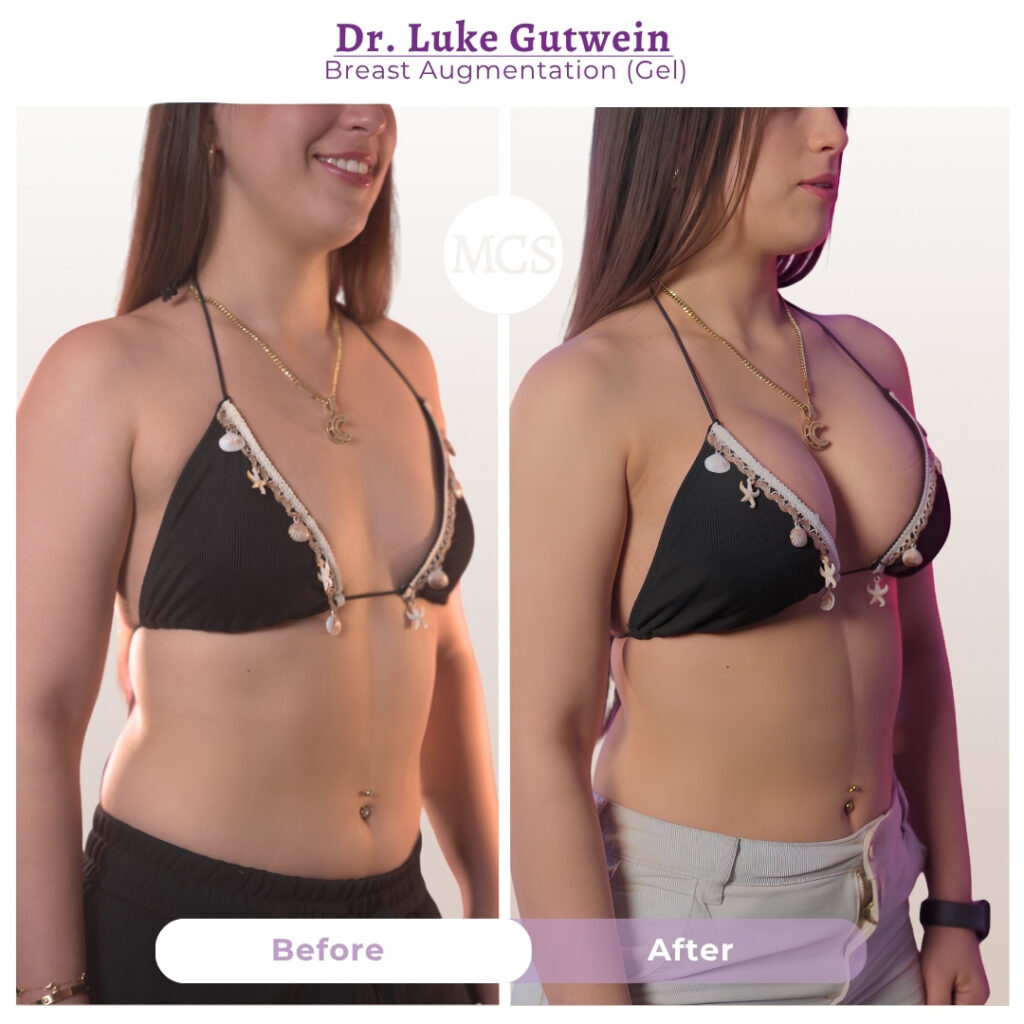 Before and after breast augmentation results performed by Dr. Luke Gutwein at My Cosmetic Surgery Miami.