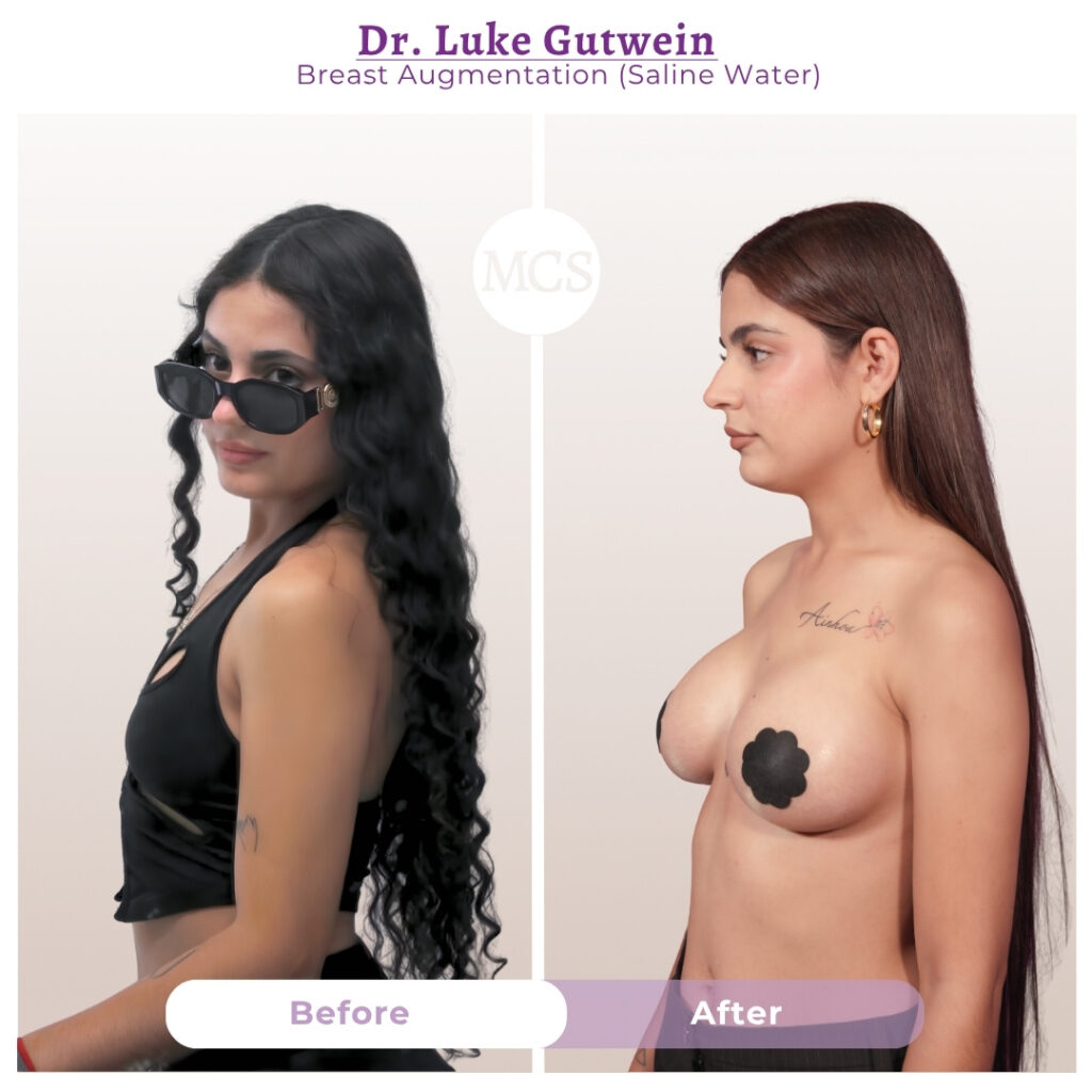 Before and after breast augmentation results with saline implants performed by Dr. Luke Gutwein at My Cosmetic Surgery Miami.