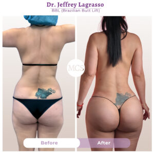 Before and after Brazilian Butt Lift (BBL) results showing enhanced buttock volume and improved body contour performed by Dr. Jeffrey Lagrasso at My Cosmetic Surgery Miami.