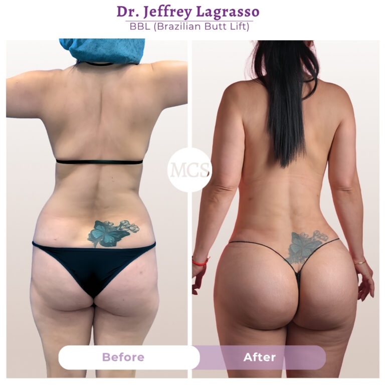 Before and after Brazilian Butt Lift (BBL) results showing enhanced buttock volume and improved body contour performed by Dr. Jeffrey Lagrasso at My Cosmetic Surgery Miami.