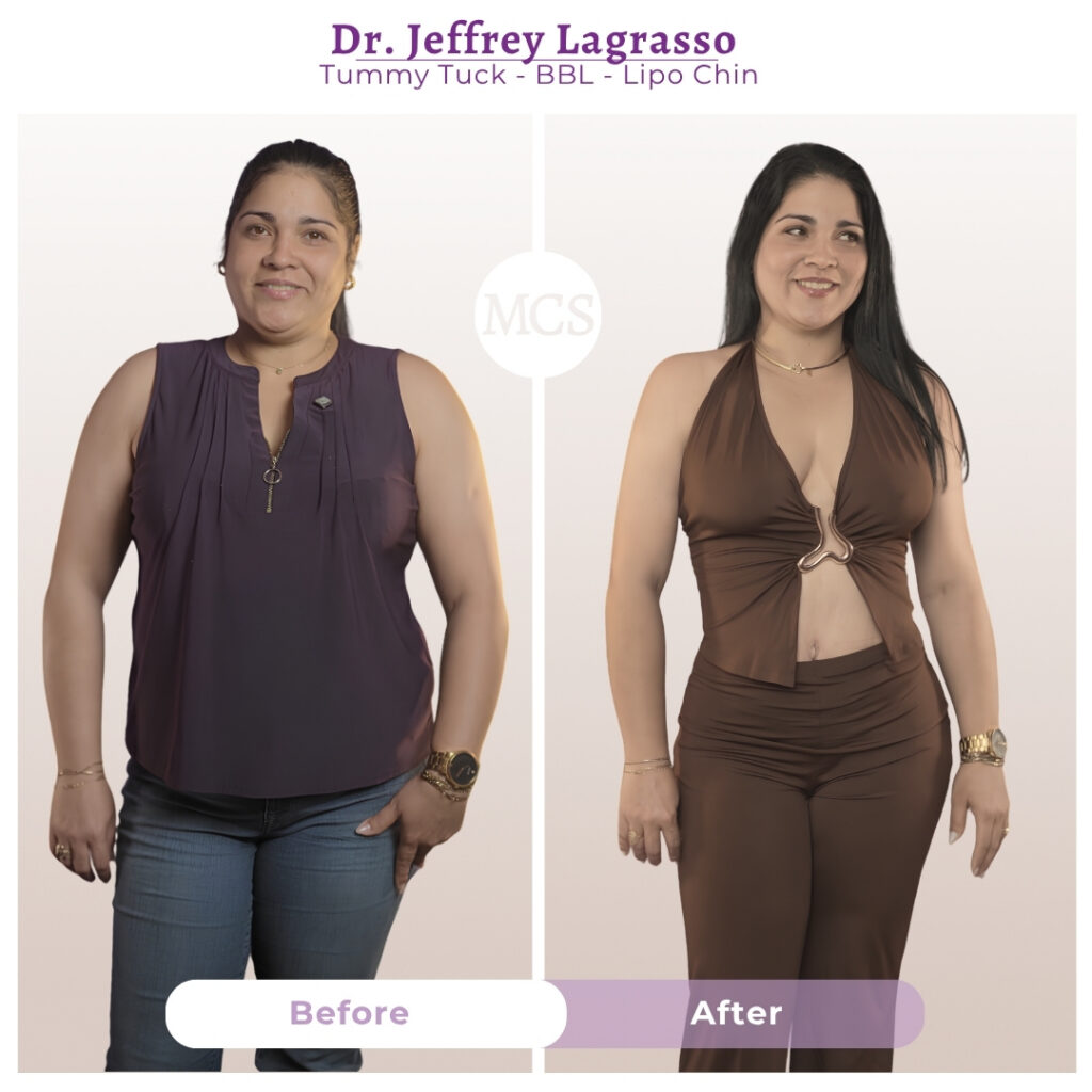 Before and after results of a tummy tuck, Brazilian Butt Lift (BBL), and chin liposuction performed by Dr. Jeffrey Lagrasso, showing a slimmer waistline, improved abdominal contour, enhanced buttock shape, and a more defined facial profile.