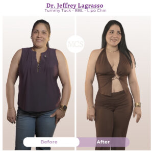 Before and after results of a tummy tuck, Brazilian Butt Lift (BBL), and chin liposuction performed by Dr. Jeffrey Lagrasso, showing a slimmer waistline, improved abdominal contour, enhanced buttock shape, and a more defined facial profile.