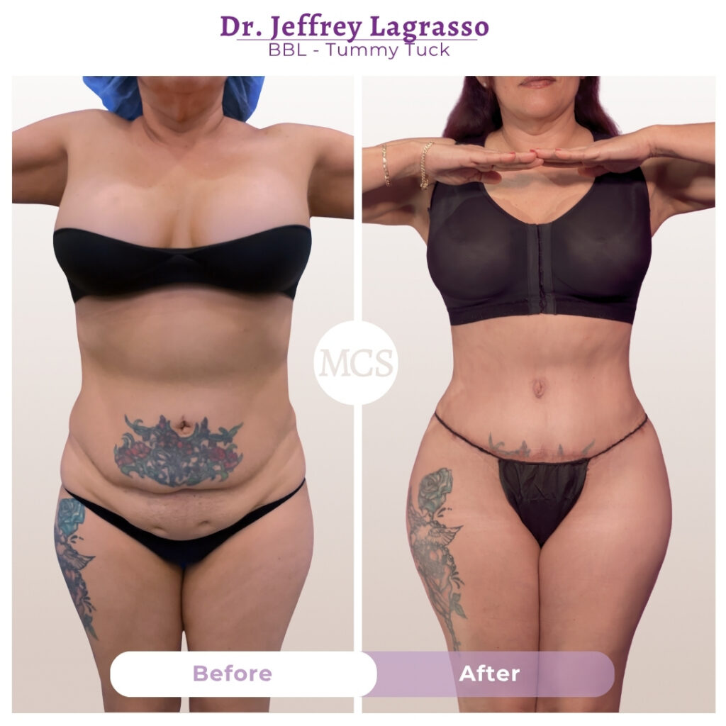 Before and after results of a tummy tuck and Brazilian Butt Lift (BBL) performed by Dr. Jeffrey Lagrasso, showing a flatter abdomen, narrower waistline, and enhanced body contours with improved lower-body proportions.