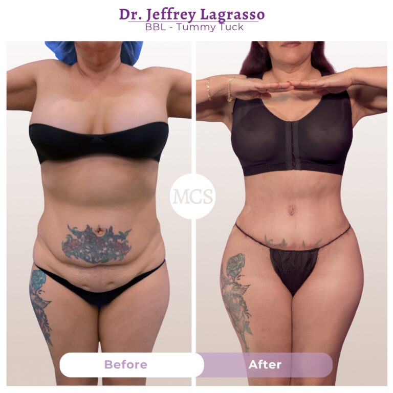 Before and after results of a tummy tuck and Brazilian Butt Lift (BBL) performed by Dr. Jeffrey Lagrasso, showing a flatter abdomen, narrower waistline, and enhanced body contours with improved lower-body proportions.