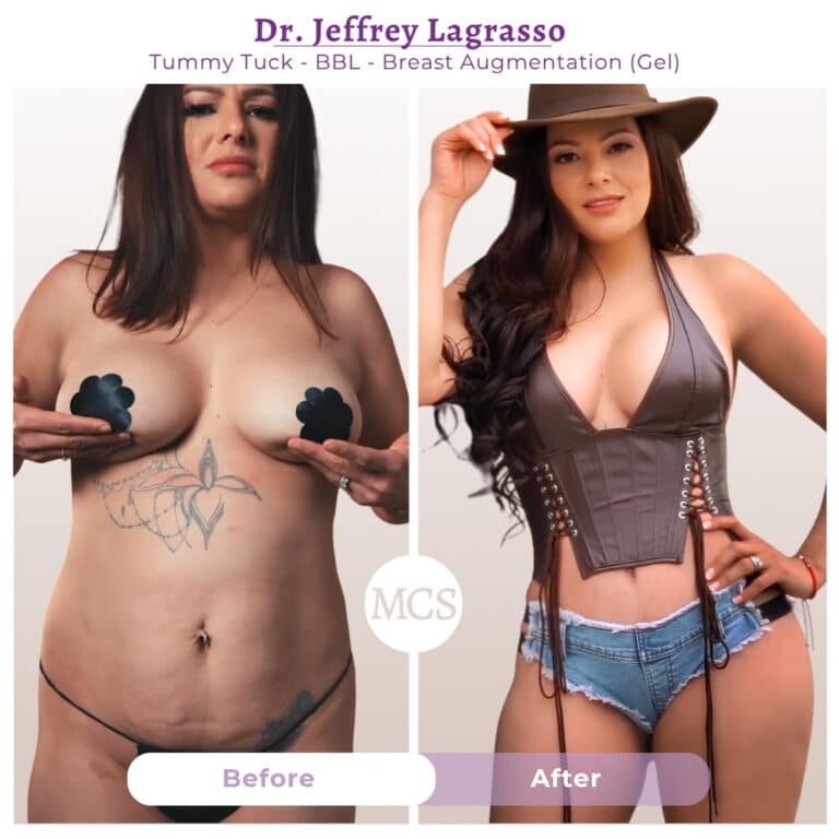 Before and after cosmetic surgery transformation at My Cosmetic Surgery Miami by Dr. Jeffrey LaGrasso, showing tummy tuck, BBL, and breast augmentation results from a front-view comparison.