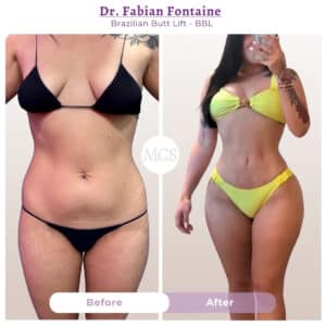Before and after Brazilian Butt Lift transformation at My Cosmetic Surgery Miami by Dr. Fabian Fontaine, showing body contouring results from a front view.