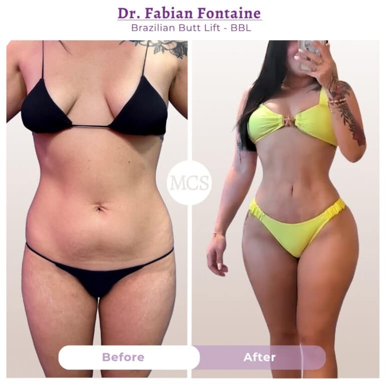 Before and after Brazilian Butt Lift transformation at My Cosmetic Surgery Miami by Dr. Fabian Fontaine, showing body contouring results from a front view.